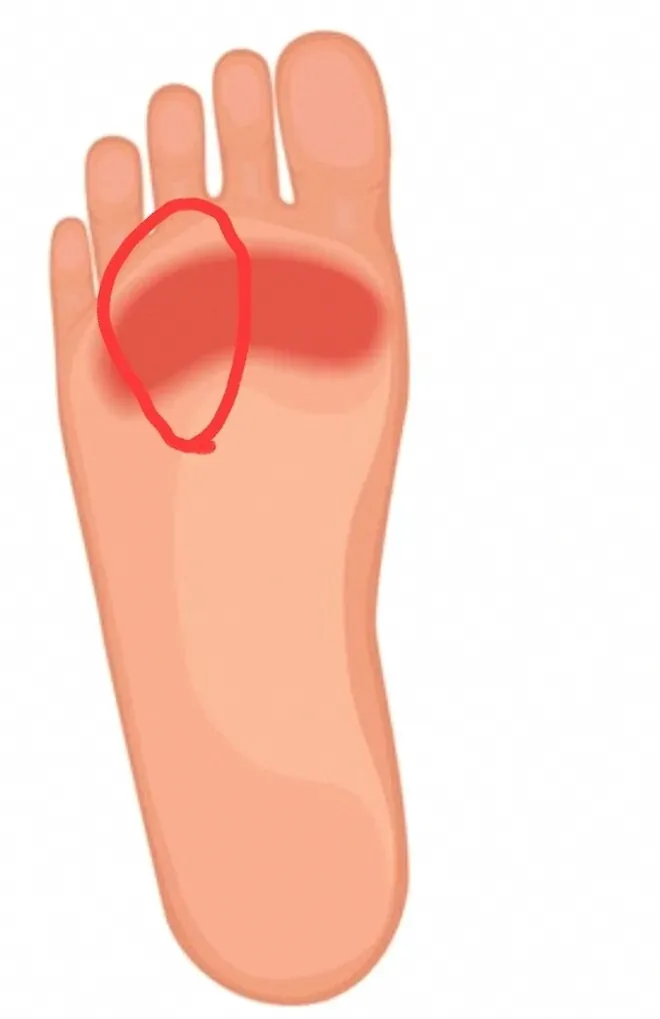 발바닥 통증 원인별 증상과 집에서 확인하는 방법 7