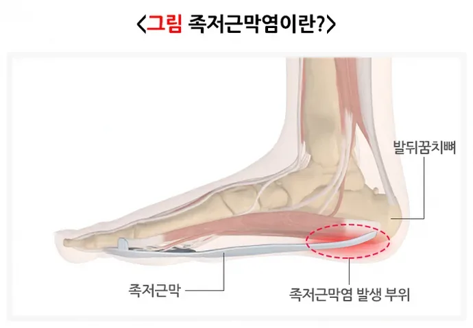 요족 발 아치 해부도