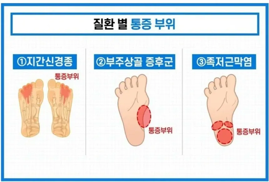 족저근막염 아침 첫 발 통증
